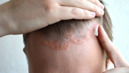 Milyen tünetei vannak a seborrheás dermatitisnek, és ki jelenik meg? Ételek, amelyek kiváltják a betegséget