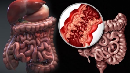 Mi a Crohn-kór? Melyek a Crohn-kór tünetei? Van gyógymód Crohnra?