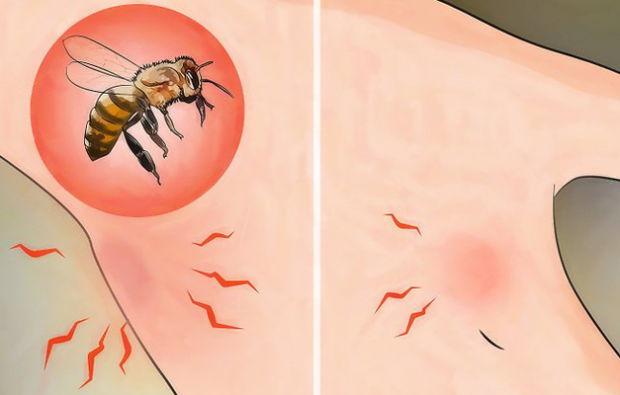 Mi a méh allergia és milyen tünetei vannak? Természetes módszerek, amelyek jóak a méhek szúrására