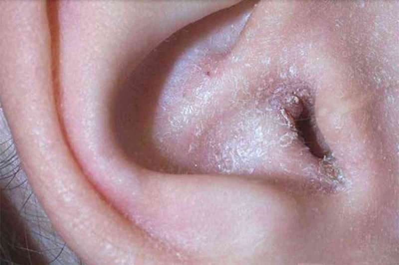 Mi okozza a fül mögötti hámlást és hogyan halad át? A fül mögötti ekcéma végleges megoldása ...