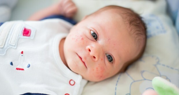 Hogyan továbbadnak a pattanások a baba arcán? Pattanás (Milia) szárítási módszerek