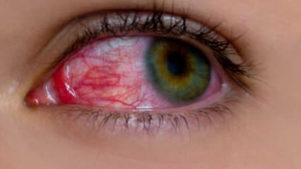 Mi okozza a szem allergiáját? Melyek a szem allergia tünetei? Mi jót tesz a szem allergiáinak? 
