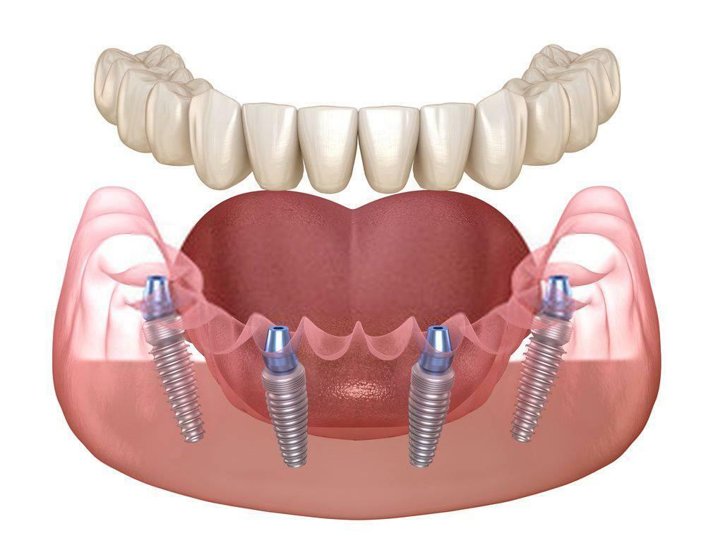 AZONNAL BEHELYEZHETEM AZ IMPLANTÁTUMOT FOGALKITÁS UTÁN?