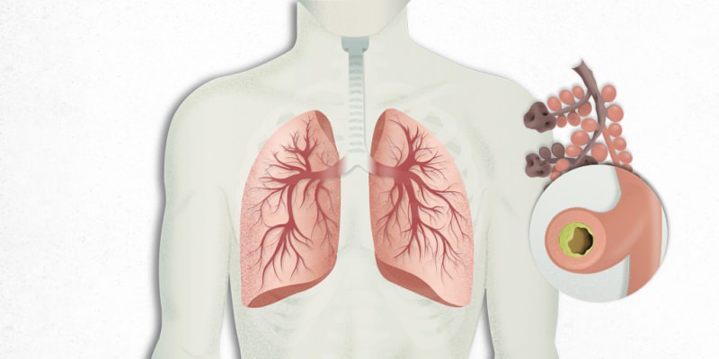 a tüdőben levő vírus keveredik a tüdőgyulladással