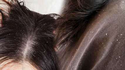 Hogyan folyik a korpásodás, és mi a jó a korpás hajhoz? Öt leggyorsabb és leghatékonyabb módszer a korpásodás eltávolítására