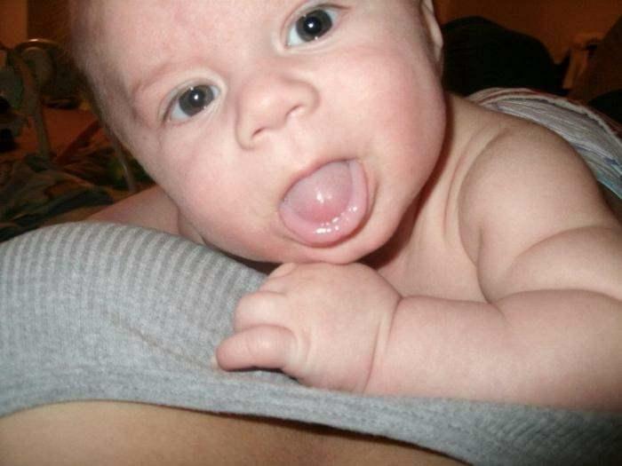 csecsemőknél kilóg a nyelv