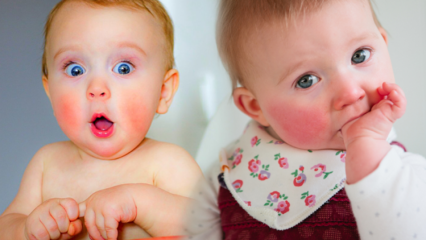 Figyelem vörös arccal rendelkező csecsemőknél! Pofontlan arcszindróma és tünetei