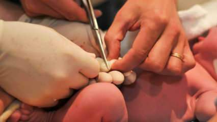 Mikor vágják el a köldökzsinórt a csecsemőknél? A köldökzsinór késői levágásának előnyei