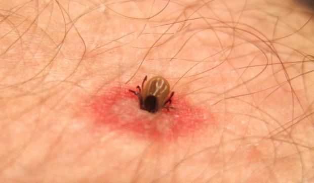 Milyen rovarharapás? Rovarcsípés tünetei! A szúnyogcsípés természetes módszere