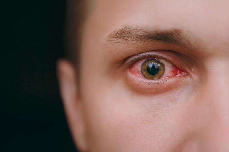 szem öntözés, vérzés és viszkető koronavírus tünetek