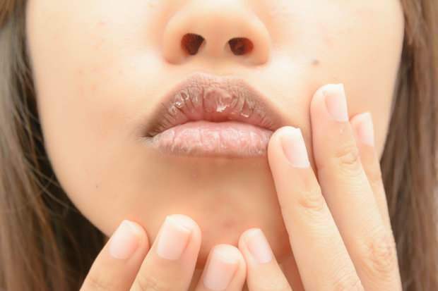 az anaemia száraz ajkakat okoz