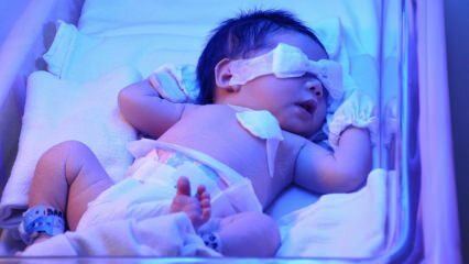 Mi az újszülött sárgaság? Hogyan jut el otthon a csecsemők sárgasága? A sárgaság foka csecsemőknél