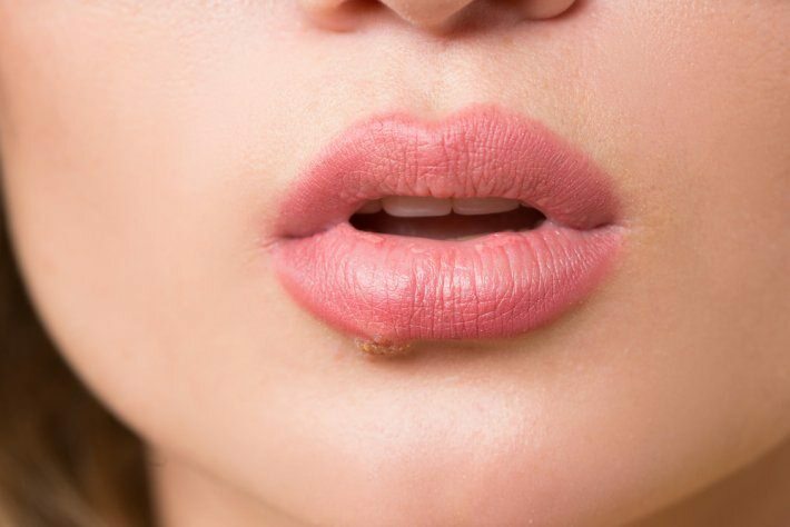 Mi a nyelvrák? Melyek a tünetek?