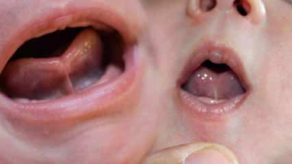 Mi a nyelvkötés (Ankyloglossi) csecsemőknél? A nyelvkötés tünetei és kezelése ...