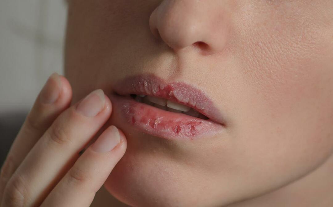 Mi okozza a sötét ajkakat? Hogyan kezelik az ajak sötétedését vagy zúzódását?