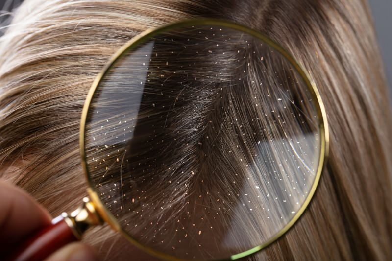 Hogyan folyik a korpásodás, és mi a jó a korpás hajhoz? Az 5 leggyorsabb és leghatékonyabb korpás elleni gyógyszer