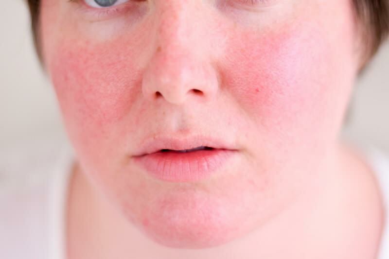Hogyan megy át a vörösített arc? A legjobb bőrápoló szerek az arcpír ellen