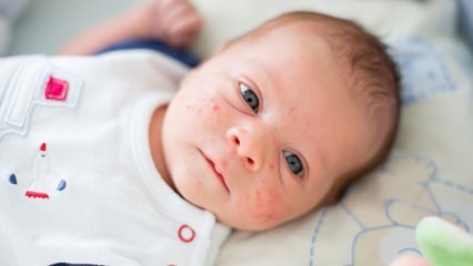 Hogyan jutnak a pattanások a baba arcára? Pattanás (Milia) szárítási módszerek