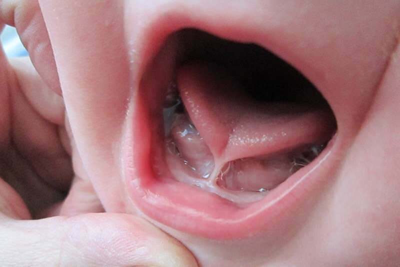 A nyelvkötés tünetei és kezelése csecsemőknél