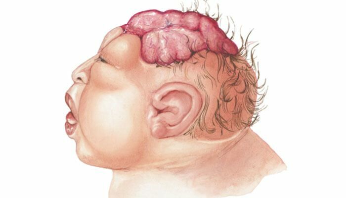 Mi az Anencephaly? Milyen tünetei vannak az csecsemők és gyermekek anencephalyának? Anencephaly okoz ...