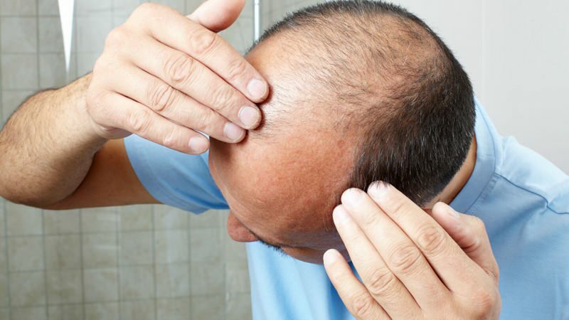 A hajátültetés megakadályozza a ghusl-t?