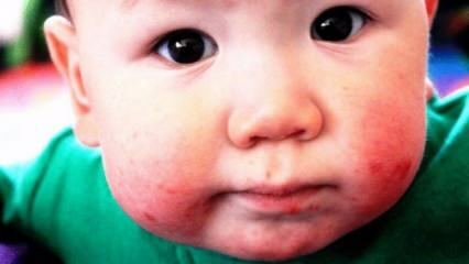 Hogyan jutnak el a szájsebek a csecsemőknél? Intraorális sebek tünetei és otthoni kezelési módszerei csecsemőknél