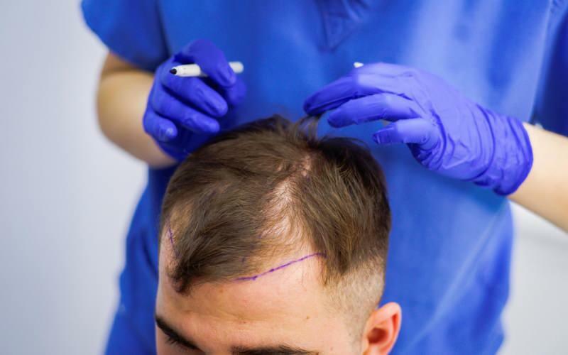Megengedett-e a hajátültetés a hajhullás kezelésében? Mi a protetikus haj? A protetikus haj akadályozza a ghusl-t?