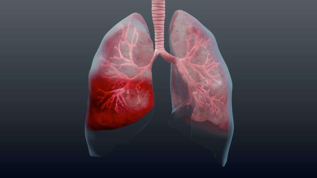 Mi a tüdőgyulladás és mik a tünetei? Hogyan kezelik az új járványos Pneumonia vírust?