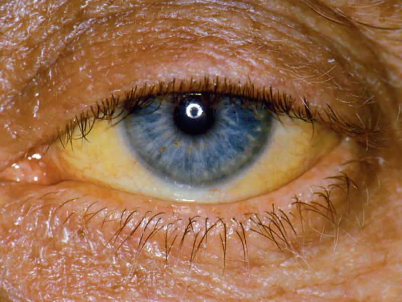 A bilirubin szint magassága sárga színt okoz a szemen és a bőrön