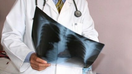 A szakértők bejelentették! Növekszik a tüdőrákos halálesetek száma