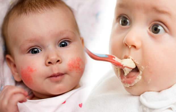 allergiás tünetek csecsemőknél