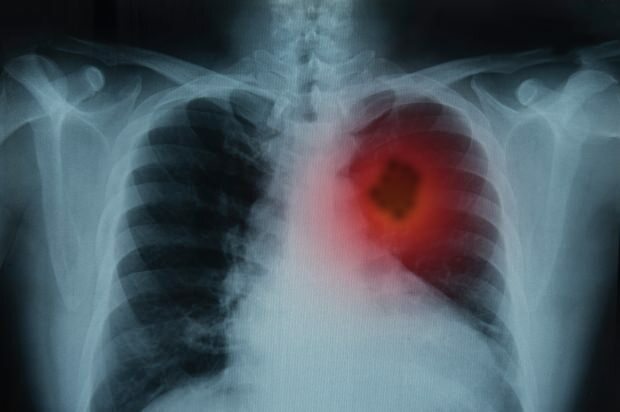 Melyek a tüdőrák tünetei? Van-e tüdőrák kezelés? A tüdőrák megelőzése ...