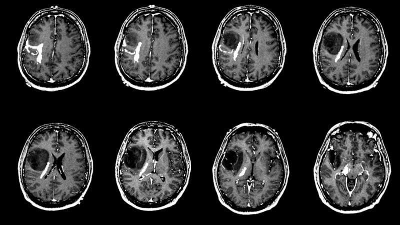 Mi okozza az agydaganatot? Melyek az agydaganat tünetei? Nehéz az agydaganat kezelése?