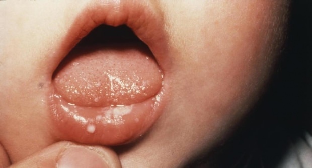 Hogyan fáj a száj csecsemőknél?