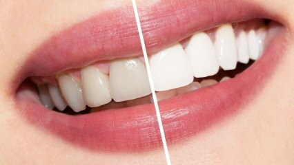 Milyen ajánlások vannak a fehér fogakra? A fogfehérítés természetes módon otthon gyógyítja meg ...