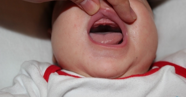 Mi az a szájhagyma csepp a csecsemőkben, miért? Tünetek és kezelés ...