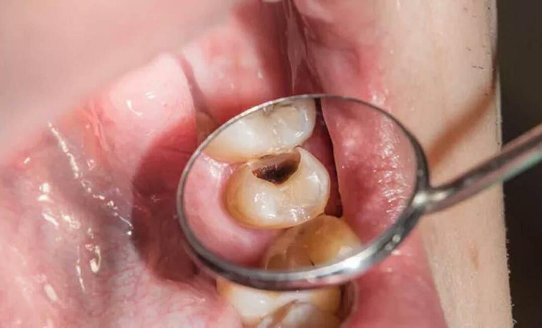 Miért rothadnak a fogak, és mit tehetünk ennek megelőzése érdekében? 