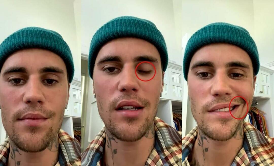 Justin Bieber arcbénulást kapott! A híres sztár nem indulhat még egyszer világkörüli körútra