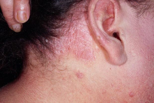 Milyen tünetei vannak a seborrheás dermatitisnek, és ki jelenik meg? Ételek, amelyek kiváltják a betegséget