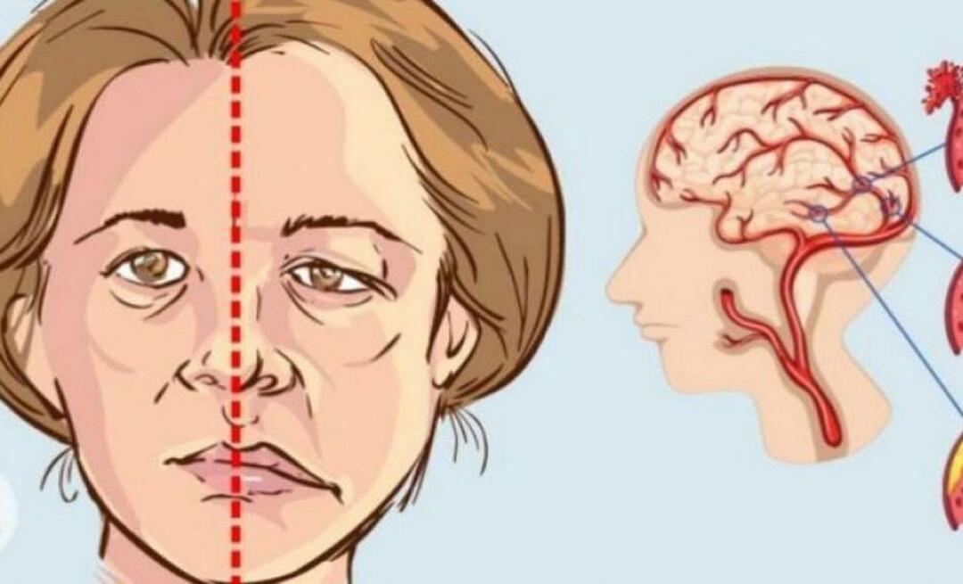 Mi az a stroke? Mik a stroke tünetei? Hogyan lehet megelőzni a stroke-ot?