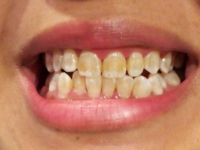 fogaképe egy olyan személyről, akinek a fogai elsötétülnek
