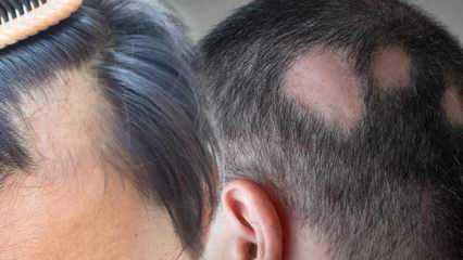 Mi az ótvar (Alopecia areata)? Melyek a ínférges tünetei? Hatékony megoldások az ótvar számára