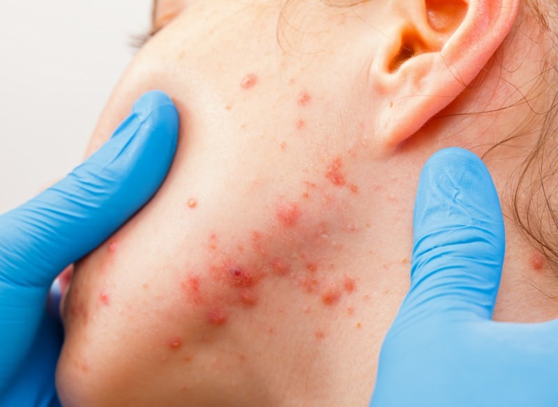 a vírus hólyagokat okoz a bőr felszínén