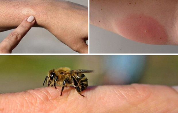 méh allergia tünetei