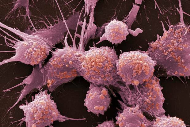 Mi a rák? Milyen tünetei vannak a ráknak? Hány rákfajta létezik? Hogyan lehet megelőzni a rákot?
